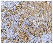 IHC staining of FFPE human breast cancer with BubR1 antibody. HIER: boil tissue sections in pH8 EDTA buffer for 20 min and allow to cool before testing.