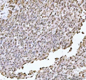 IHC staining of FFPE human testicular germ cell tumor tissue with DHX15 antibody. HIER: boil tissue sections in pH8 EDTA for 20 min and allow to cool before testing.
