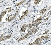 IHC staining of FFPE human breast cancer with RICTOR antibody. HIER: boil tissue sections in pH8 EDTA for 20 min and allow to cool before testing.