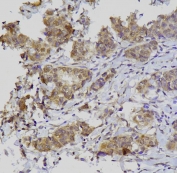 IHC staining of FFPE human breast cancer with GATA3 antibody. HIER: boil tissue sections in pH8 EDTA for 20 min and allow to cool before testing.