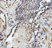 IHC staining of FFPE human prostate cancer with MMP2 antibody. HIER: boil tissue sections in pH8 EDTA for 20 min and allow to cool before testing.