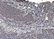 IHC staining of FFPE human lung cancer with HDAC5 antibody. HIER: boil tissue sections in pH8 EDTA for 20 min and allow to cool before testing.