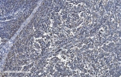 IHC staining of FFPE human melanoma with VDAC3 antibody. HIER: boil tissue sections in pH8 EDTA for 20 min and allow to cool before testing.