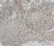 IHC staining of FFPE human testis cancer with VDAC3 antibody. HIER: boil tissue sections in pH8 EDTA for 20 min and allow to cool before testing.