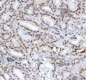 IHC staining of FFPE human prostate cancer tissue with CDK12 antibody. HIER: boil tissue sections in pH8 EDTA for 20 min and allow to cool before testing.