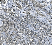 IHC staining of FFPE human breast cancer with EFT1 antibody. HIER: boil tissue sections in pH8 EDTA for 20 min and allow to cool before testing.