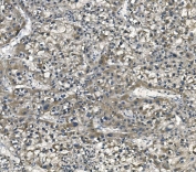IHC staining of FFPE human liver cancer with EFT1 antibody. HIER: boil tissue sections in pH8 EDTA for 20 min and allow to cool before testing.
