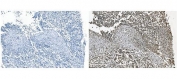IHC staining of FFPE human pancreatic cancer with GRSF1 antibody (right) and negative control (left). HIER: boil tissue sections in pH8 EDTA for 20 min and allow to cool before testing.