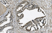 IHC staining of FFPE human prostate cancer with GRSF1 antibody. HIER: boil tissue sections in pH8 EDTA for 20 min and allow to cool before testing.