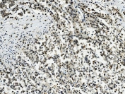 IHC staining of FFPE human pancreatic cancer with Transketolase antibody. HIER: boil tissue sections in pH8 EDTA for 20 min and allow to cool before testing.