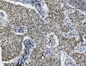 IHC staining of FFPE human lung cancer with Transketolase antibody. HIER: boil tissue sections in pH8 EDTA for 20 min and allow to cool before testing.