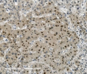 IHC staining of FFPE human liver cancer with Transketolase antibody. HIER: boil tissue sections in pH8 EDTA for 20 min and allow to cool before testing.