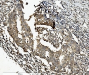 IHC staining of FFPE human breast cancer with CASP7 antibody. HIER: boil tissue sections in pH8 EDTA for 20 min and allow to cool before testing.