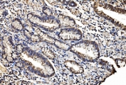 IHC staining of FFPE human gastric cancer with CASP7 antibody. HIER: boil tissue sections in pH8 EDTA for 20 min and allow to cool before testing.