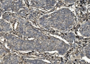 IHC staining of FFPE human lung cancer with CASP7 antibody. HIER: boil tissue sections in pH8 EDTA for 20 min and allow to cool before testing.