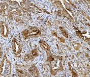 IHC staining of FFPE human gallbladder adenocarcinoma tissue with PDIR antibody. HIER: boil tissue sections in pH8 EDTA for 20 min and allow to cool before testing.
