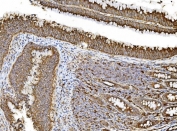IHC staining of FFPE human rectal cancer tissue with PDIR antibody. HIER: boil tissue sections in pH8 EDTA for 20 min and allow to cool before testing.