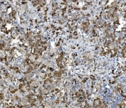 IHC staining of FFPE human lung cancer tissue with PDIR antibody. HIER: boil tissue sections in pH8 EDTA for 20 min and allow to cool before testing.