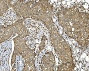 IHC staining of FFPE human breast cancer tissue with PDIR antibody. HIER: boil tissue sections in pH8 EDTA for 20 min and allow to cool before testing.