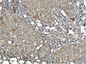 IHC staining of FFPE human breast cancer with ERp5 antibody. HIER: boil tissue sections in pH8 EDTA for 20 min and allow to cool before testing.