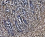 IHC staining of FFPE human rectal cancer with ERp5 antibody. HIER: boil tissue sections in pH8 EDTA for 20 min and allow to cool before testing.