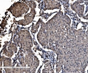 IHC staining of FFPE human breast cancer tissue with DYNLL1 antibody. HIER: boil tissue sections in pH8 EDTA for 20 min and allow to cool before testing.