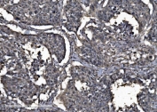 IHC staining of FFPE human lung cancer tissue with DYNLL1 antibody. HIER: boil tissue sections in pH8 EDTA for 20 min and allow to cool before testing.