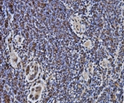 IHC staining of FFPE human gallbladder adenocarcinoma lymphoid tissue with DYNLL1 antibody. HIER: boil tissue sections in pH8 EDTA for 20 min and allow to cool before testing.