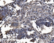 IHC staining of FFPE human cervical cancer tissue with DYNLL1 antibody. HIER: boil tissue sections in pH8 EDTA for 20 min and allow to cool before testing.