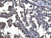 IHC staining of FFPE human ovarian cancer tissue with DYNLL1 antibody. HIER: boil tissue sections in pH8 EDTA for 20 min and allow to cool before testing.