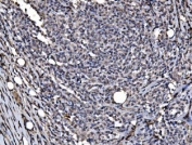 IHC staining of FFPE human lymphoma tissue with DYNLL1 antibody. HIER: boil tissue sections in pH8 EDTA for 20 min and allow to cool before testing.