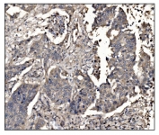 IHC staining of FFPE human lung cancer tissue with Deoxyhypusine synthase antibody. HIER: boil tissue sections in pH8 EDTA for 20 min and allow to cool before testing.