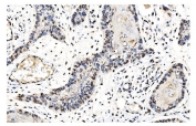 IHC staining of FFPE human esophageal squamous carcinoma tissue with GOLM1 antibody. HIER: boil tissue sections in pH8 EDTA for 20 min and allow to cool before testing.