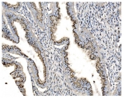 IHC staining of FFPE human cervical intraepithelial neoplasia tissue with GOLM1 antibody. HIER: boil tissue sections in pH8 EDTA for 20 min and allow to cool before testing.