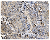 IHC staining of FFPE human lung cancer tissue with GOLM1 antibody. HIER: boil tissue sections in pH8 EDTA for 20 min and allow to cool before testing.
