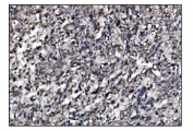 IHC staining of FFPE human liver cancer tissue with SLFN11 antibody. HIER: boil tissue sections in pH8 EDTA for 20 min and allow to cool before testing.
