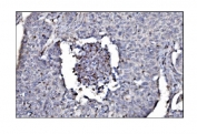 IHC staining of FFPE human lung cancer tissue with SLFN11 antibody. HIER: boil tissue sections in pH8 EDTA for 20 min and allow to cool before testing.