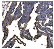 IHC staining of FFPE human colon cancer tissue with IGF2R antibody. HIER: boil tissue sections in pH8 EDTA for 20 min and allow to cool before testing.