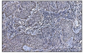 IHC staining of FFPE human lung cancer tissue with COPS5 antibody. HIER: boil tissue sections in pH8 EDTA for 20 min and allow to cool before testing.