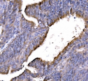 IHC staining of FFPE human rectal cancer tissue with GGA3 antibody. HIER: boil tissue sections in pH8 EDTA for 20 min and allow to cool before testing.