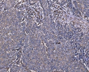 IHC staining of FFPE human lung cancer tissue with Integrin Linked Kinase antibody. HIER: boil tissue sections in pH8 EDTA for 20 min and allow to cool before testing.