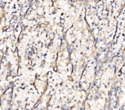 IHC staining of FFPE human renal clear cell carcinoma tissue with Integrin Linked Kinase antibody. HIER: boil tissue sections in pH8 EDTA for 20 min and allow to cool before testing.