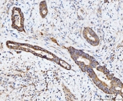 IHC staining of FFPE human bladder adenosquamous carcinoma tissue with ECSIT antibody. HIER: boil tissue sections in pH8 EDTA for 20 min and allow to cool before testing.