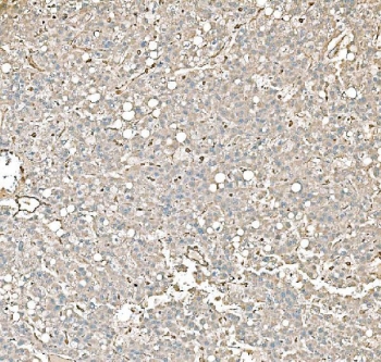 IHC staining of FFPE human liver cancer tissue with Pyruvate Kinase antibody. HIER: boil tissue sections in pH8 EDTA for 20 min and allow to cool before testing.