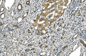 IHC staining of FFPE human liver cancer tissue with NLRP7 antibody. HIER: boil tissue sections in pH8 EDTA for 20 min and allow to cool before testing.