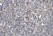 IHC staining of FFPE human lymphoma tissue with NLRP7 antibody. HIER: boil tissue sections in pH8 EDTA for 20 min and allow to cool before testing.