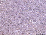 IHC staining of FFPE human colonic adenocarcinoma tissue with HLA-DRA antibody. HIER: boil tissue sections in pH8 EDTA for 20 min and allow to cool before testing.