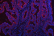 Immunofluorescent staining of FFPE human rectal cancer with TRMT2B antibody (red) and DAPI nuclear stain (blue). HIER: steam section in pH8 EDTA buffer for 20 min.