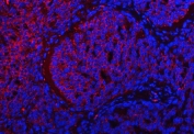 Immunofluorescent staining of FFPE human lung squamous cell carcinoma with TRMT2B antibody (red) and DAPI nuclear stain (blue). HIER: steam section in pH8 EDTA buffer for 20 min.