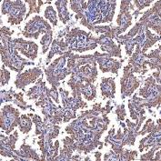 IHC staining of FFPE human lung cancer tissue with TRMT2B antibody. HIER: boil tissue sections in pH8 EDTA for 20 min and allow to cool before testing.